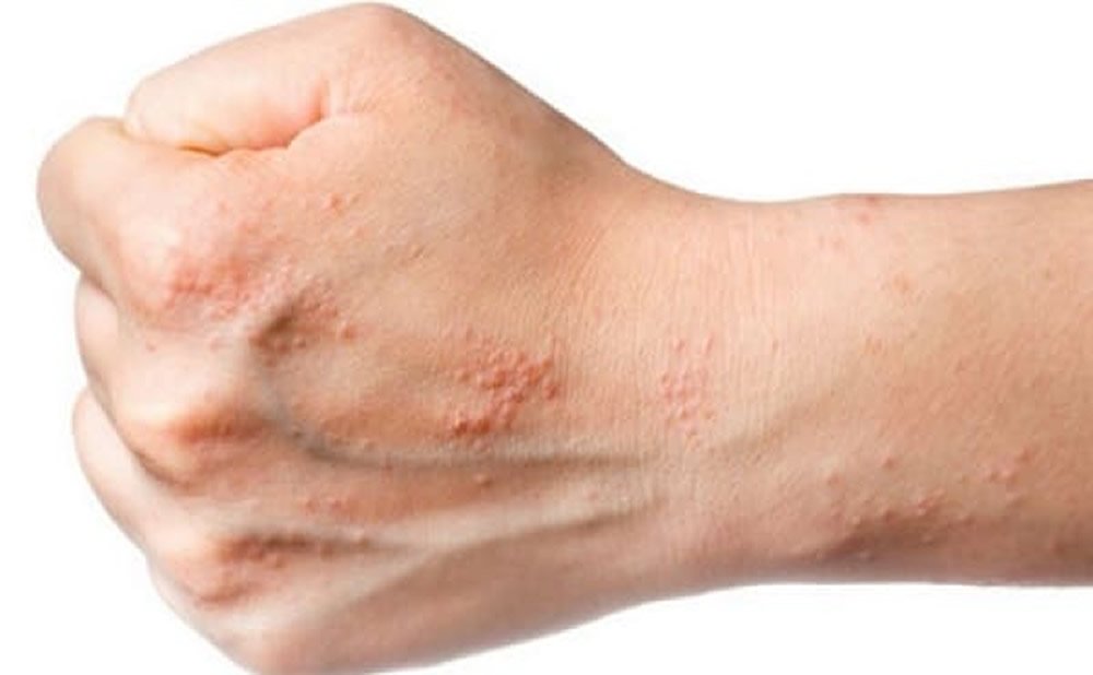 ¿Qué son los sarpullidos por estrés?