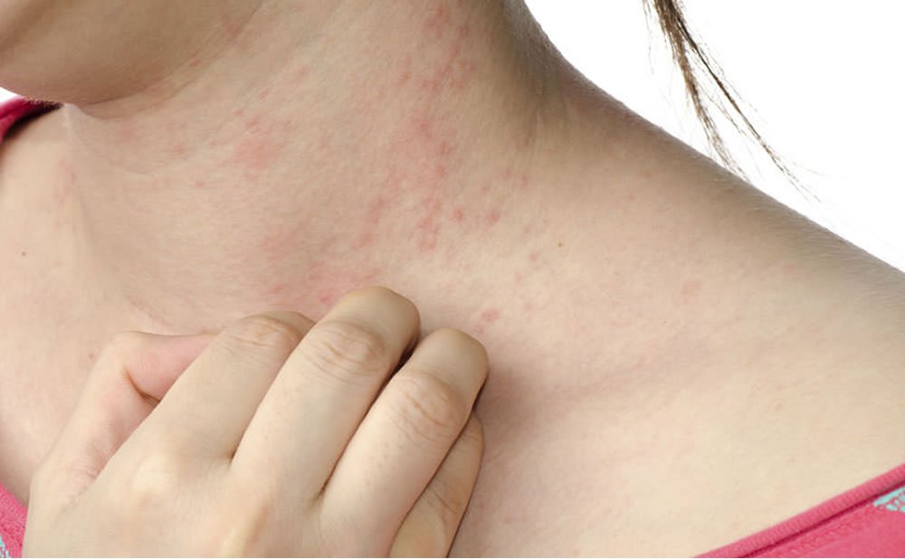 Eczema como fumar puede dañar su piel