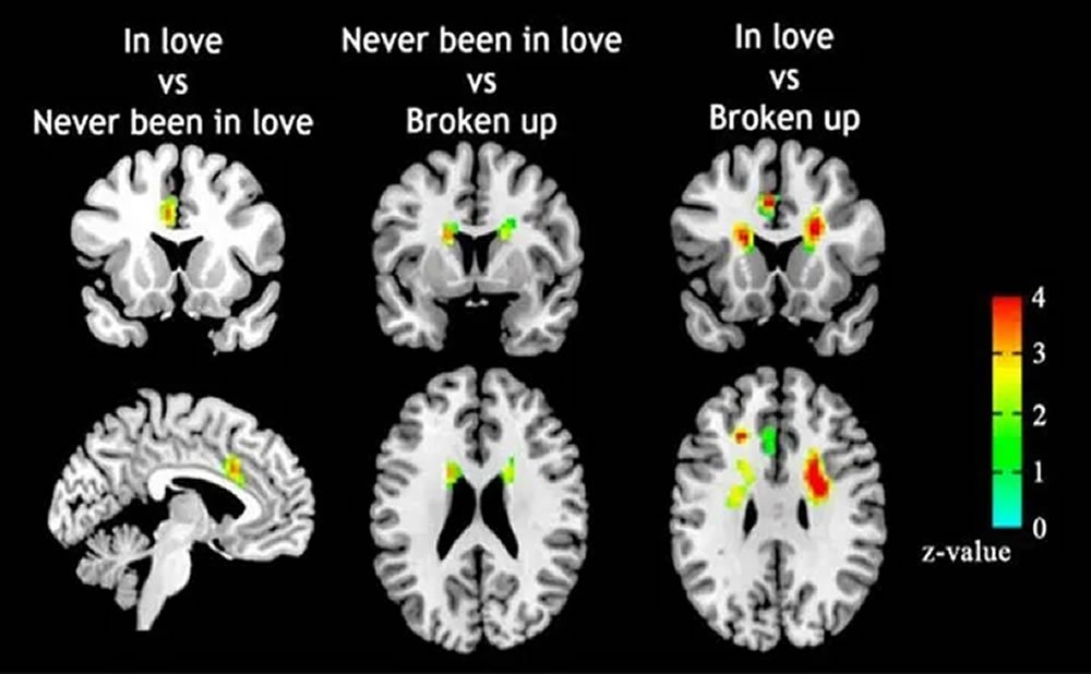Regiones del cerebro involucradas en la atraccion y el romance que sucede en tu cerebro cuando te enamoras